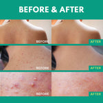 Adellina Back blemish Spray, Body blemish care with Salicylic Acid, Tea Tree Oil & Niacinamide, 4 oz