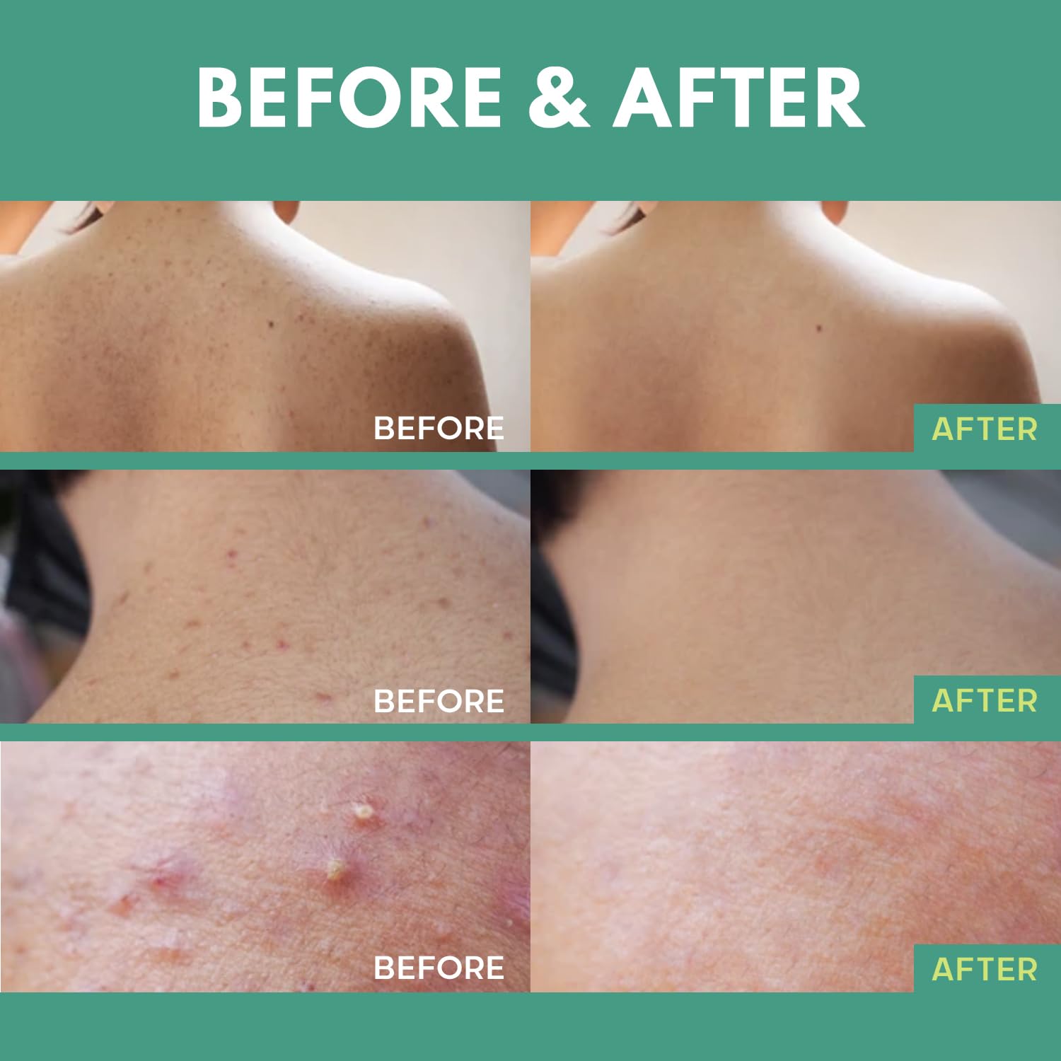 Adellina Back blemish Spray, Body blemish care with Salicylic Acid, Tea Tree Oil & Niacinamide, 4 oz