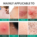 Adellina Back blemish Spray, Body blemish care with Salicylic Acid, Tea Tree Oil & Niacinamide, 4 oz